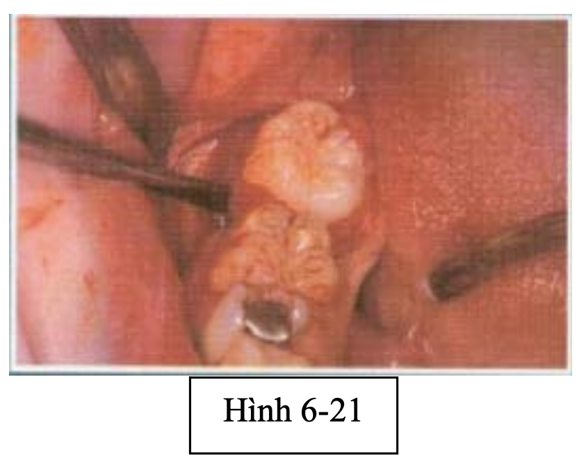 Quy trình phẫu thuật răng khôn: những nguyên tắc cơ bản